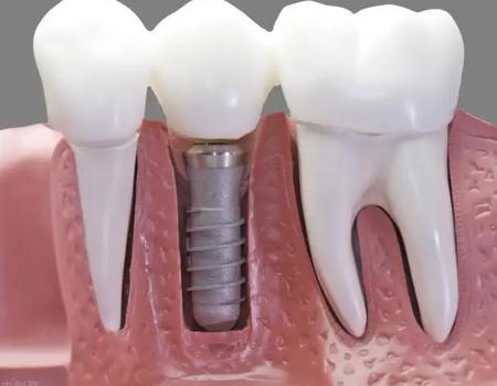 厦门牙齿种植为什么需要植骨粉