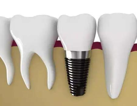 厦门牙齿种植在什么情况下需要植骨