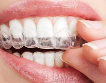 在厦门牙齿矫正用哪种牙套比较有效果