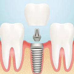 牙齿破损到什么程度需要种植牙？