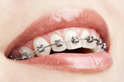 牙齿矫正后为什么会牙龈萎缩？