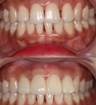 牙缝大有哪些牙齿修复方式