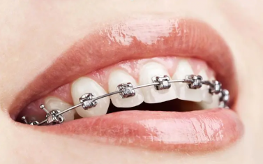 厦门牙齿矫正的方法包括哪些