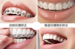 厦门牙齿隐形矫正的常见方式