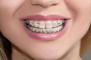 牙齿矫正期间不护理好可能造成的伤害